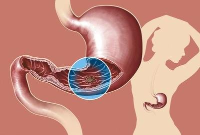 做好這些|慢性萎縮性胃炎離胃癌就會更遠(yuǎn)！